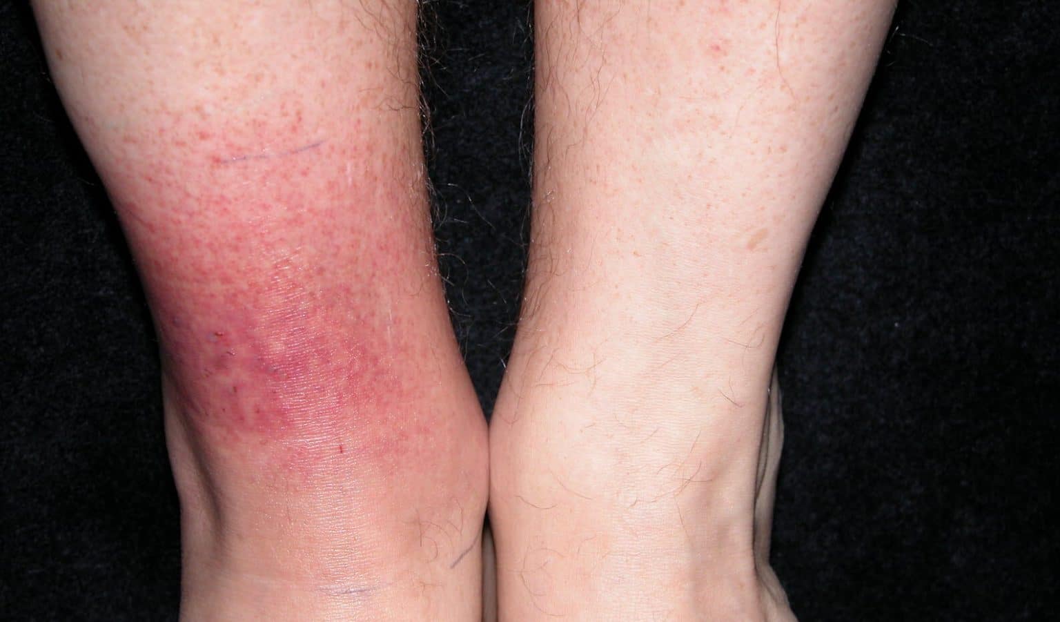 Quelles sont les conséquences de la maladie de Lyme ? Bargemon.fr