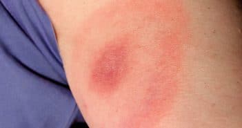 Quelles sont les conséquences de la maladie de Lyme ?